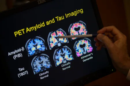 Want to lower your risk of dementia? It doesn't involve a blood test